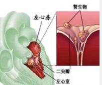 引发老年人心内膜炎的病因是什么 你都了解吗