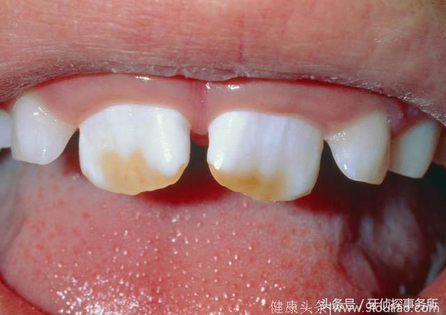 6种异常变色的牙齿该如何处理？