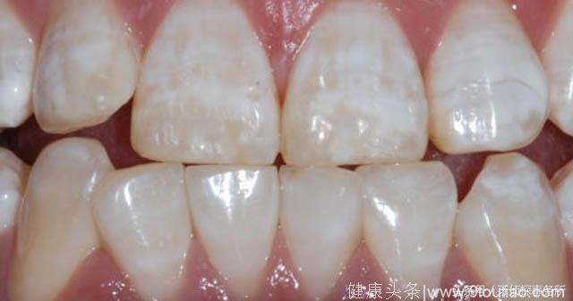 6种异常变色的牙齿该如何处理？