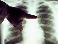 晚期肺癌患者如何保守治疗呢