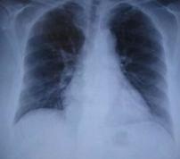 晚期肺癌患者如何保守治疗呢