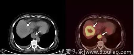 PET-CT如何发现肺癌的复发、转移？