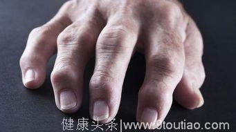 掰手指关节容易得关节炎？别再被这个谣言忽悠了