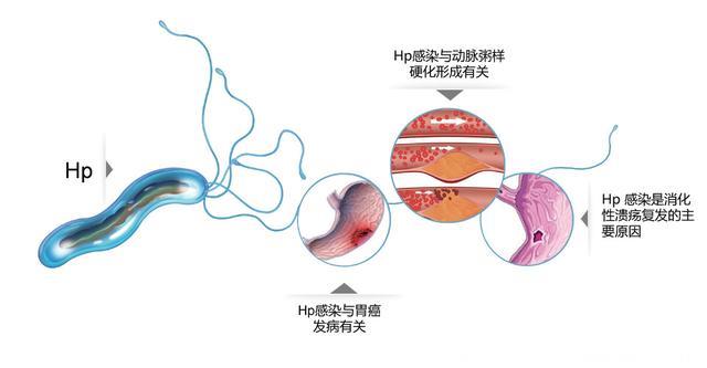 吃饭竟被传染上癌症？80%以上人都感染，比乙肝更可怕！