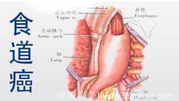 专家讲解食道癌症状 早发现这些症状是治疗关键