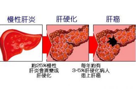 慢性肝炎！肝硬化！肝癌！教你如何看懂肝功能化验单？