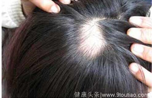 专家详解，斑秃脱发原因和应对生发方法