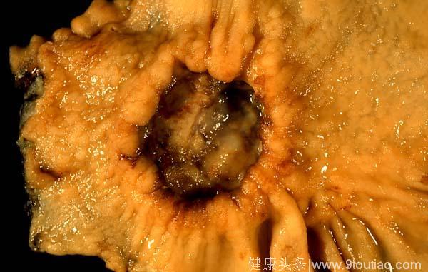 胃炎，并感染了幽门螺旋杆菌，一种叶子泡水可以阻断癌变！