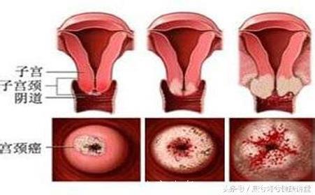 宫颈癌：会传染的癌症！年轻女性发病率持续上升