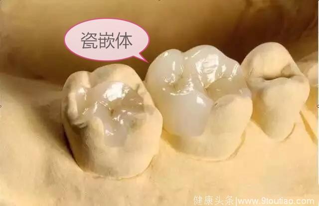 嵌体补牙与树脂补牙有什么区别？哪种比较好？