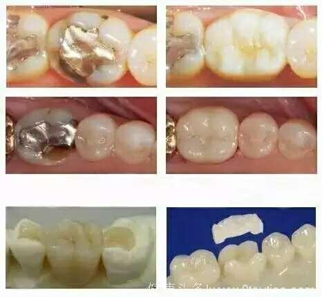 嵌体补牙与树脂补牙有什么区别？哪种比较好？