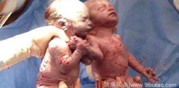 28岁孕妇辛苦怀上双胞胎，产检得知连体，坚持生下来后收获惊喜