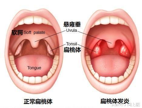 口腔健康非小事，这3种口腔癌可能一发现即是晚期！