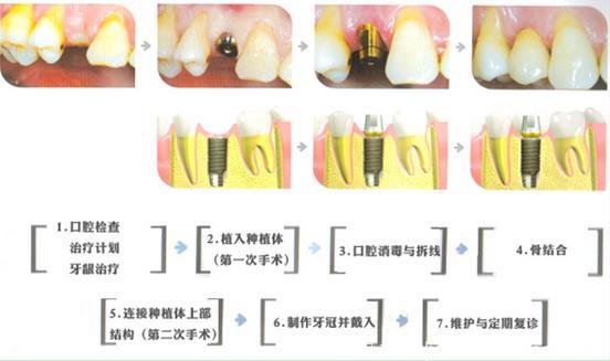 种植牙过程分为几个步骤？