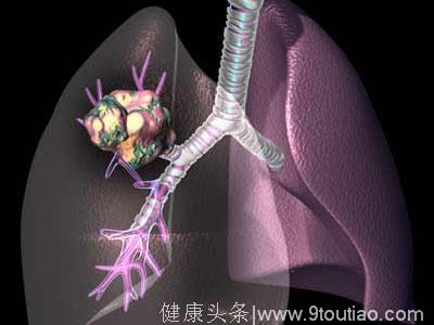 肺癌来临时会发出的3个身体暗号，早知道能救命！