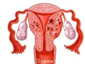 结核性输卵管炎初期大致有几种类型