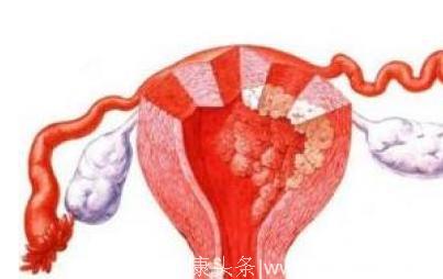 细了解，到底子宫内膜癌转移的症状有哪些呢？