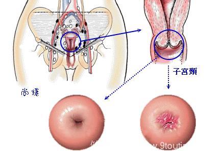 细了解，到底子宫内膜癌转移的症状有哪些呢？