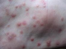 6年湿疹难治愈，多亏护士给的湿疹小克星，2周赶走湿疹，皮肤变嫩
