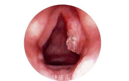 声门下型喉癌症状有哪些呢