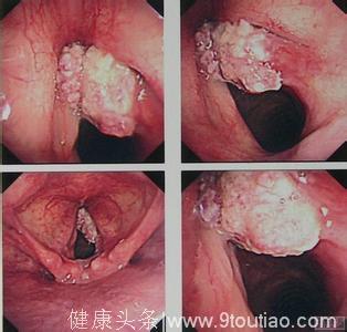 声门下型喉癌症状有哪些呢