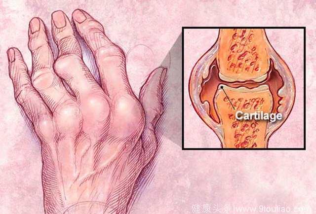 关节肿大变形，发热，身体瘦弱，头眩欲吐，该用什么方？