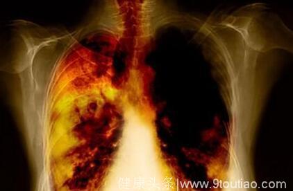 早期肺癌如何及时发现？30岁后还抽烟的，都看看