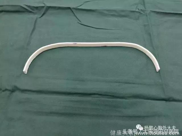 大庆首例3D打印技术辅助下的剑突下小切口胸腔镜漏斗胸矫形术（改良NUSS手术）在大庆油田总医院完成