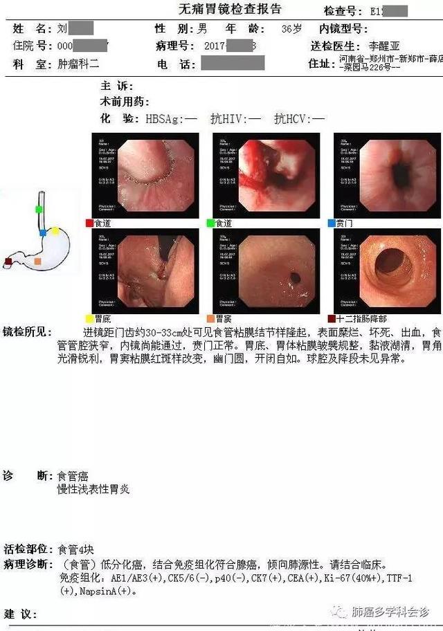 病例参考：食管癌和肺癌到底谁转移给谁？邻近器官的癌症转移实例