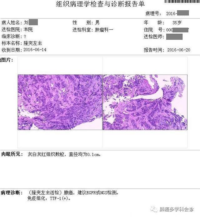 病例参考：食管癌和肺癌到底谁转移给谁？邻近器官的癌症转移实例