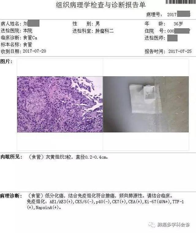 病例参考：食管癌和肺癌到底谁转移给谁？邻近器官的癌症转移实例