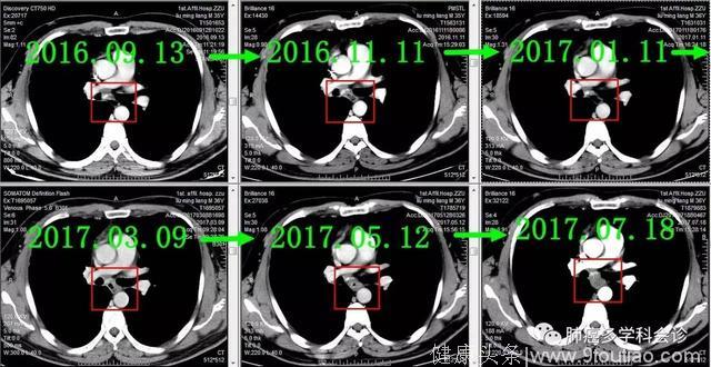 病例参考：食管癌和肺癌到底谁转移给谁？邻近器官的癌症转移实例