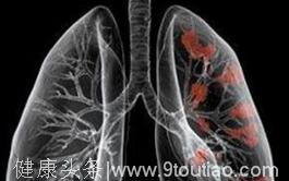 肺癌晚期6大症状要牢记
