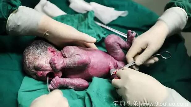 50岁孕妇超预产11天，医生紧急剖腹后，手术室里弥漫着恶臭味