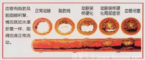 看耳朵判断有无冠心病，迷信还是科学？