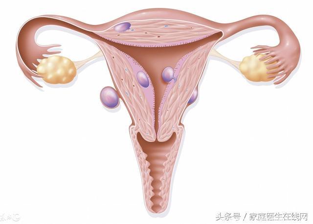 妇科医生：子宫肌瘤总爱找这6类人，希望你没有在其中
