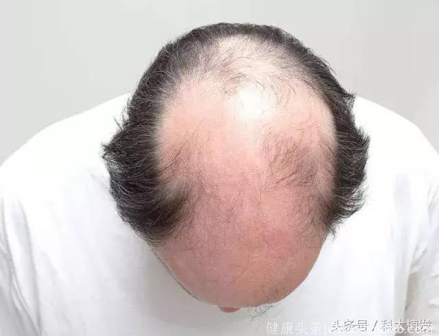 拒做油腻“中年人”，警惕男性型脱发！