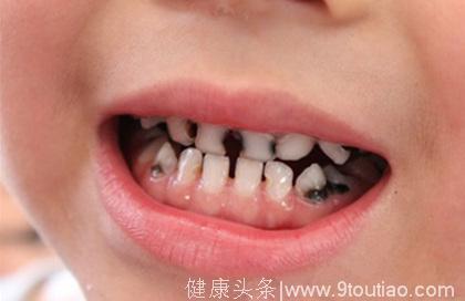 预防学前儿童龋齿是一场长期的过程