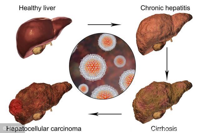 慢性肝病的护理方式