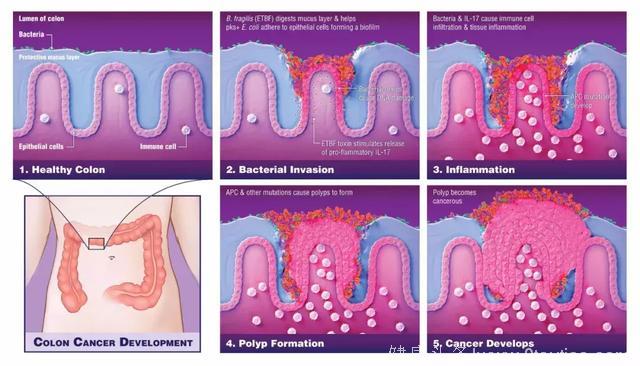 两种肠道细菌联手共同推动结肠癌的发生