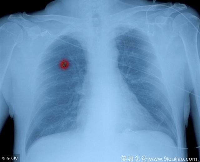 中央型肺癌早期症状，5大症状一出现，提示你已经得肺癌癌了