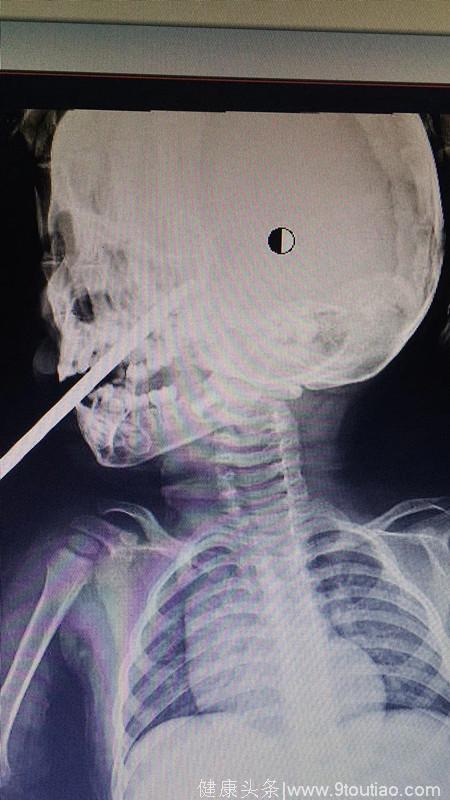 2岁男孩螺丝刀从口腔戳入上颚，幸及时手术脱离危险