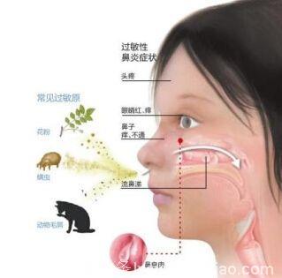 儿童哮喘合并过敏性鼻炎