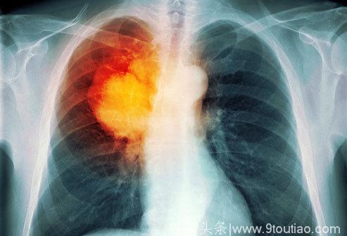 肺癌死亡率高，发现太晚、治疗太晚！分辨肺癌与一般肺疾的异同点