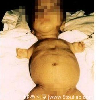 45岁孕妇因孕期少吃了它，怀胎8月被迫引产，医生呵斥太无知