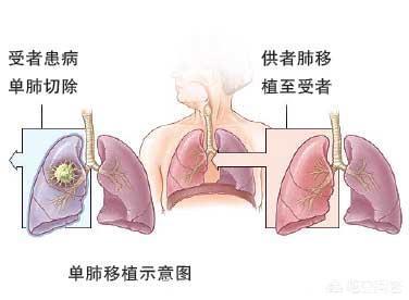 花大价钱到外国做肺癌手术到底值不值得，我院外科进修医生告诉你