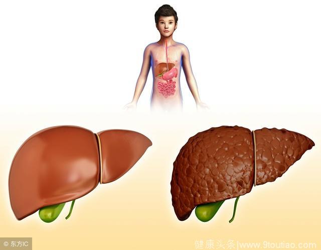 4个症状一出现肝病或已找上你，发现有任何1个都要及时保养肝脏了