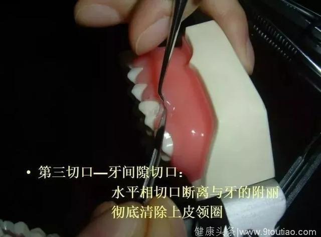 口腔医师临床技能—松牙固定术