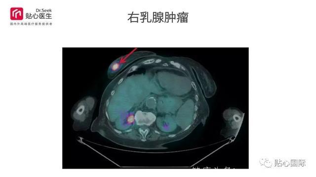 质子治疗—最好的癌症治疗权威案例