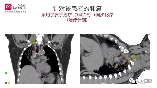 质子治疗—最好的癌症治疗权威案例